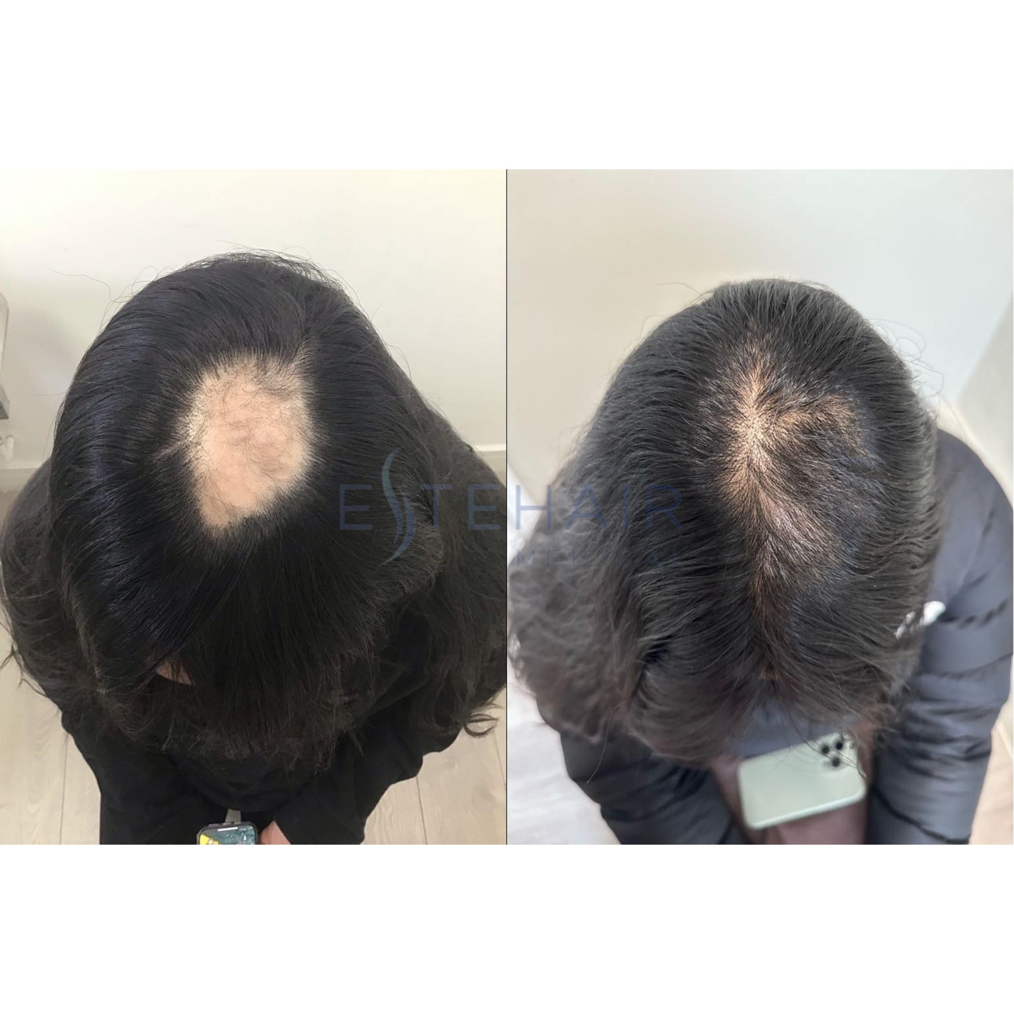 EsteAlopecia (1)